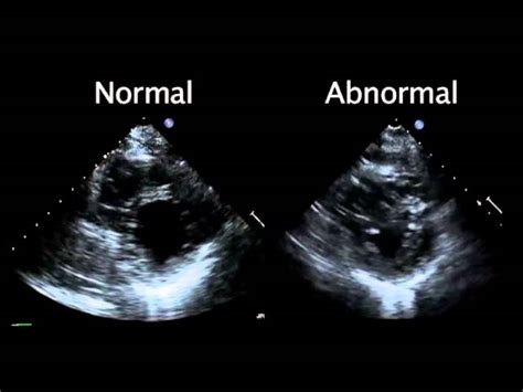 normal echocardiography report|Understanding Normal VS Abnormal Echocardiogram Results.